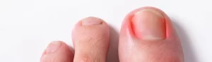 Close-up de um dedão do pé com unha encravada, apresentando vermelhidão e inflamação nas laterais da unha.