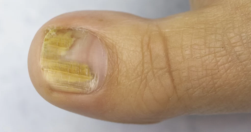 Imagem de unha com micose e descolamento, evidenciando sinais de infecção e danos à estrutura da unha.