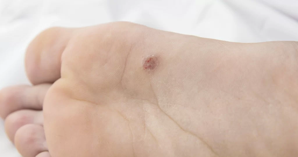 Close-up de olho de peixe (verruga plantar) na sola do pé, em estágio inicial, com pele levemente avermelhada ao redor da lesão.