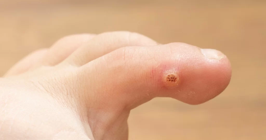 Olho de peixe na lateral do dedo do pé, com lesão arredondada e pontos escurecidos visíveis.