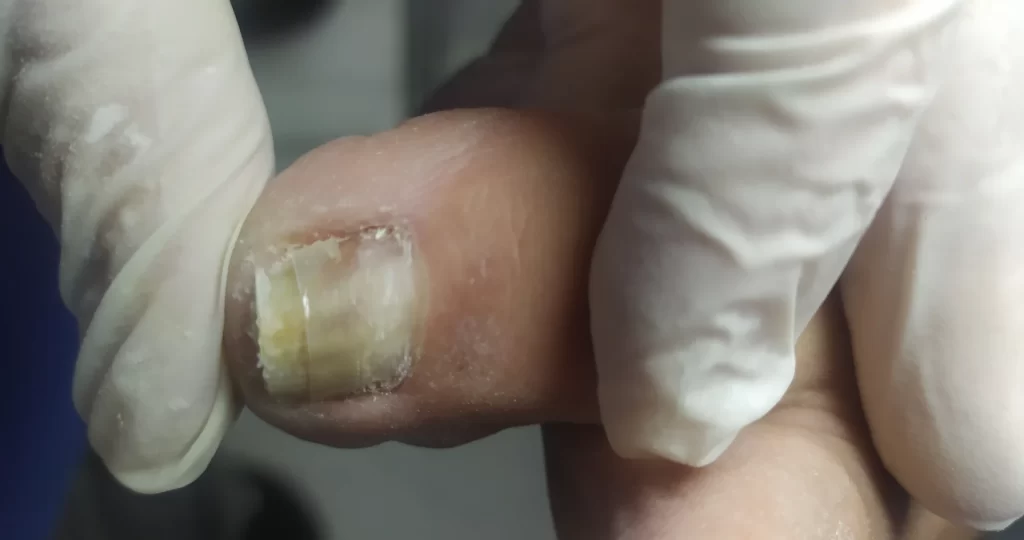 Aplicação de órtese corretiva na unha do dedão, técnica podológica usada para tratar unhas encravadas ou com curvatura alterada