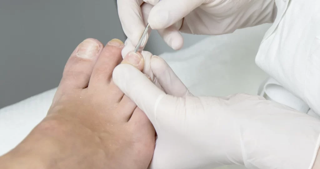 Podólogo realizando procedimento de limpeza e cuidado com as unhas dos pés, utilizando luvas e instrumentos esterilizados.