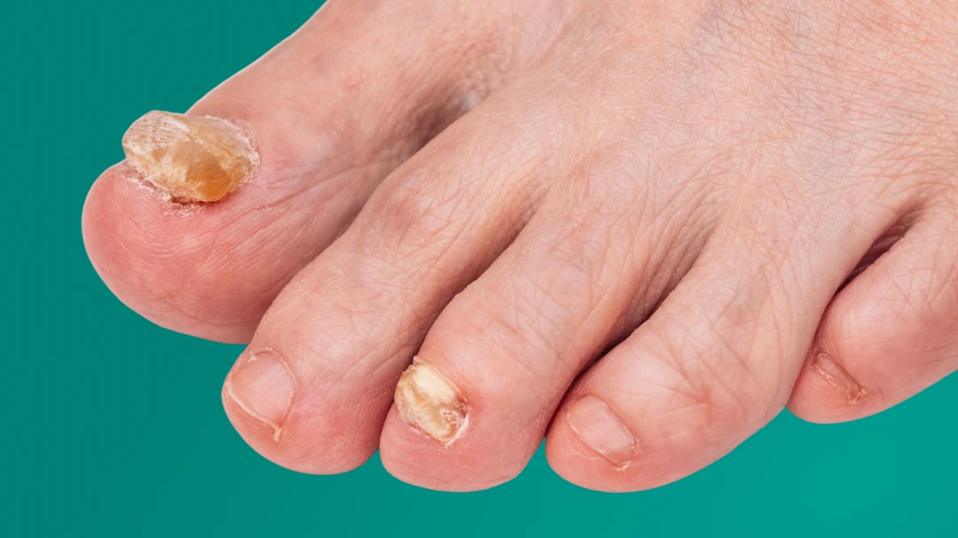 Unhas dos pés com sinais visíveis de micose, espessadas, amareladas e deformadas, indicando infecção fúngica