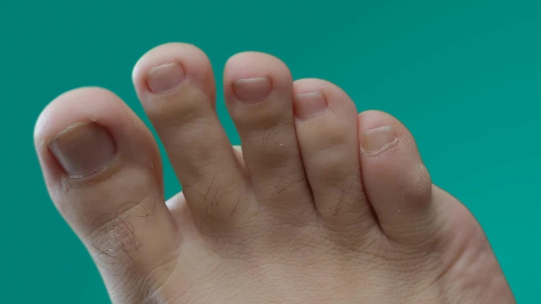 Unha encravada no dedão do pé com leve inflamação na lateral, indicando necessidade de cuidado podológico