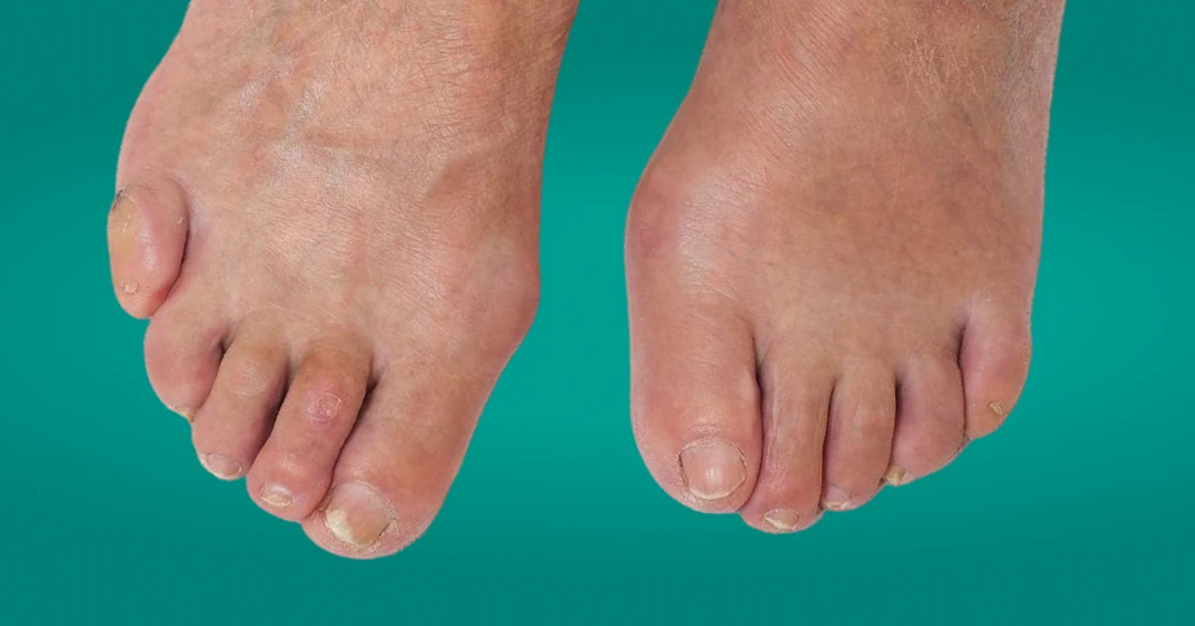 Pés com sinais de alterações provocadas por diabetes, como calosidades, deformidades e unhas com micose, demonstrando a necessidade de cuidados podológicos