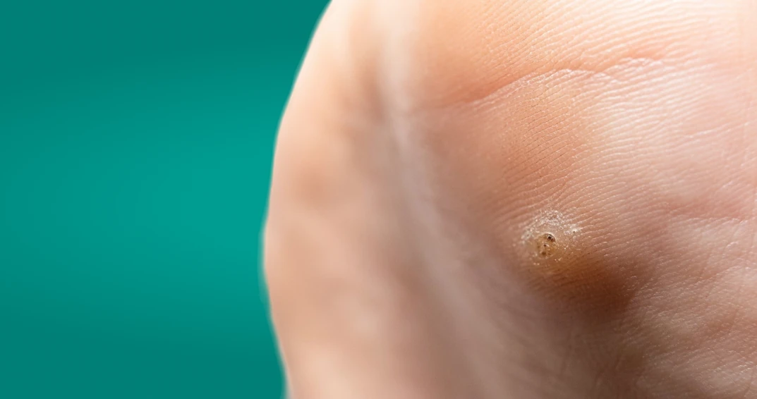 Verruga plantar no pé, lesão causada pelo vírus HPV, localizada na sola com aspecto endurecido e dolorido