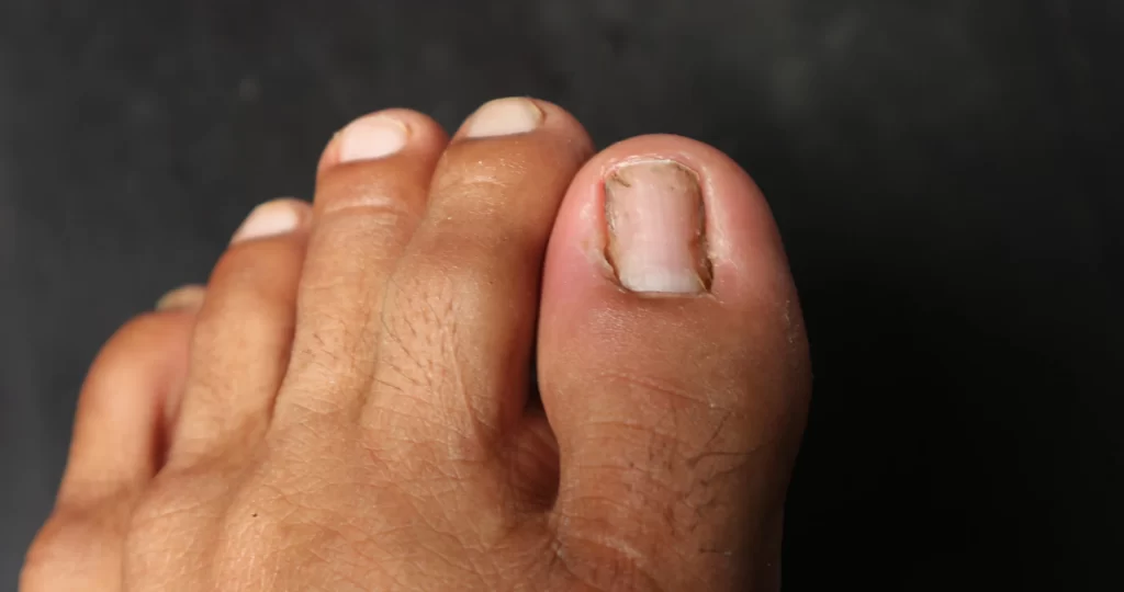 Imagem de unha encravada com curvatura acentuada, mostrando sinais de inflamação e desconforto ao redor da unha.