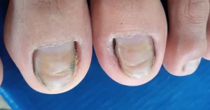 Unhas encravadas e inflamadas com coloração alterada e acúmulo de resíduos, indicando possível infecção fúngica ou bacteriana