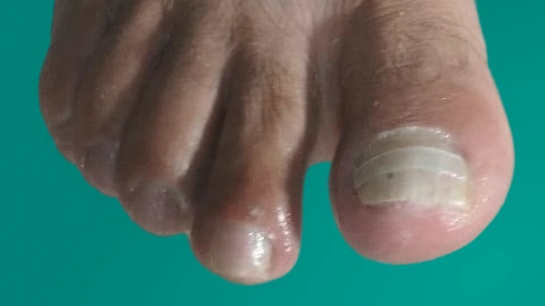Correção de unha com órtese em podologia para alinhar a curvatura da unha