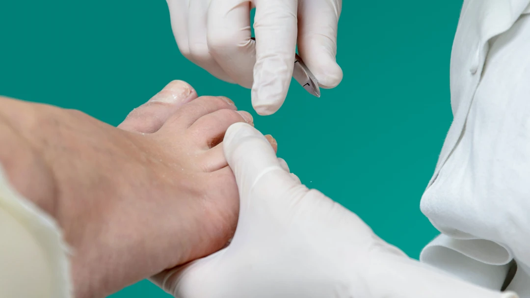 Atendimento de podologia preventiva com profissional utilizando luvas e bisturi