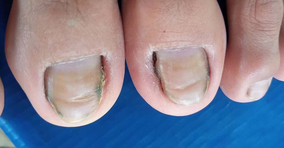 Unhas encravadas e inflamadas com coloração alterada e acúmulo de resíduos, indicando possível infecção fúngica ou bacteriana